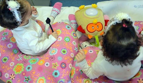 意大利儿科医生使用3D打印模型成功完成连体双胞胎分离手术