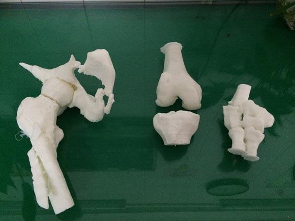 奉化区人民医院成功开展3例3D打印骨科模型手术
