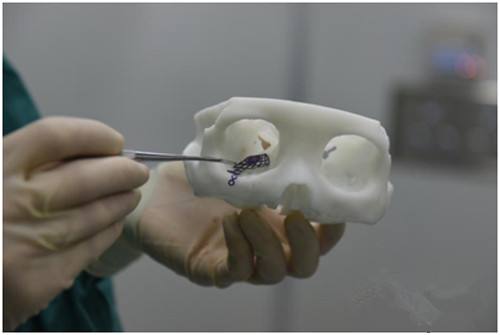 潍坊首例“3d打印眼眶成型术”在潍坊市中医院顺利完成