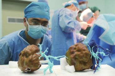 医生借助3D打印术开展高难度纵隔肿瘤切除手术