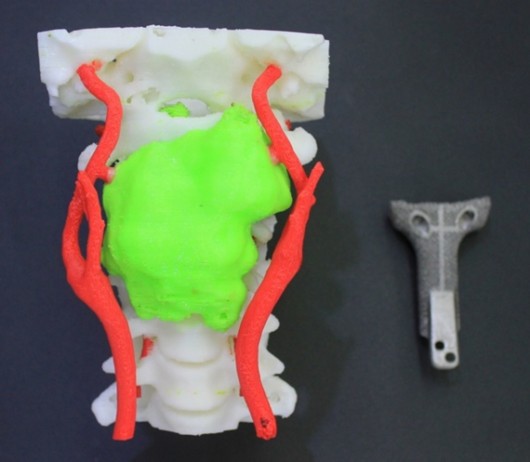 长征医院成功完成世界首例3D打印人工寰枢椎复合假体置换术