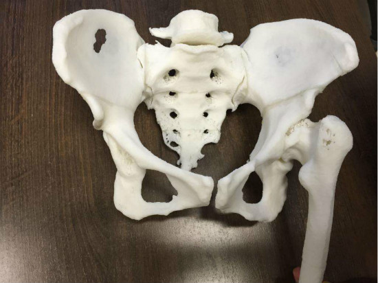 复旦大学附属中山医院骨科成功完成数例运用3D打印技术的髋关节外科手术