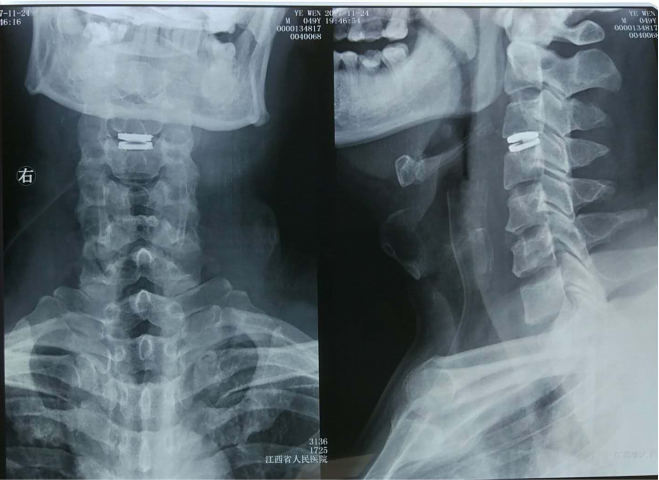 国内首例新型人工颈椎间盘置换手术在江西省人民医院成功完成