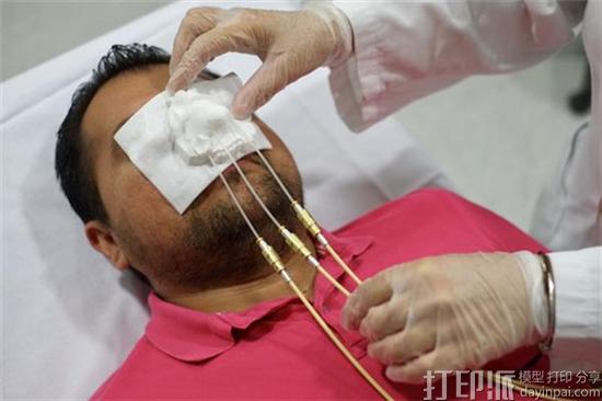 西班牙研究人员开发出可改善皮肤癌放疗治疗的3D打印保护装置 西班牙研究人员开发出可改善皮肤癌放疗治疗的3D打印保护装置