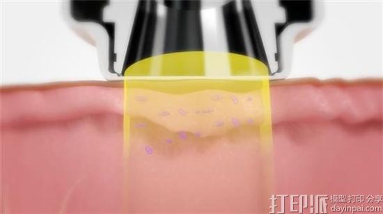 西班牙研究人员开发出可改善皮肤癌放疗治疗的3D打印保护装置 西班牙研究人员开发出可改善皮肤癌放疗治疗的3D打印保护装置