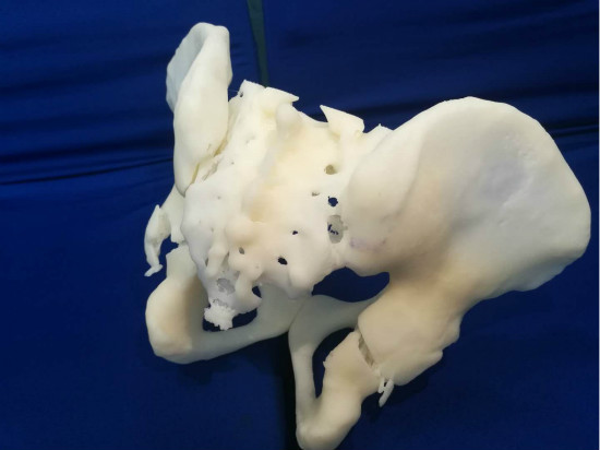 天津第四中心医院骨科成功应用3D打印完成一例复杂骨盆骨折手术