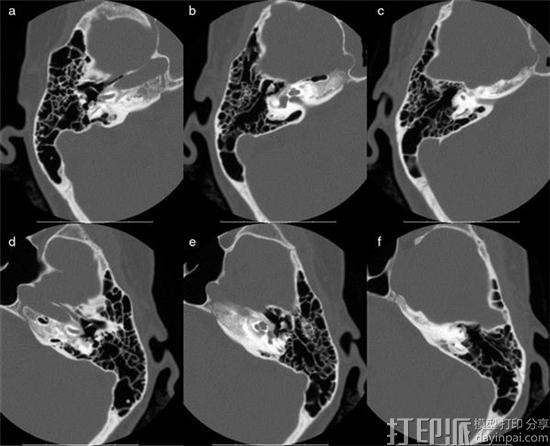 科学家开发出定制3D打印听小骨假体 可改善传导性耳聋患者的治疗 科学家开发出定制3D打印听小骨假体 可改善传导性耳聋患者的治疗