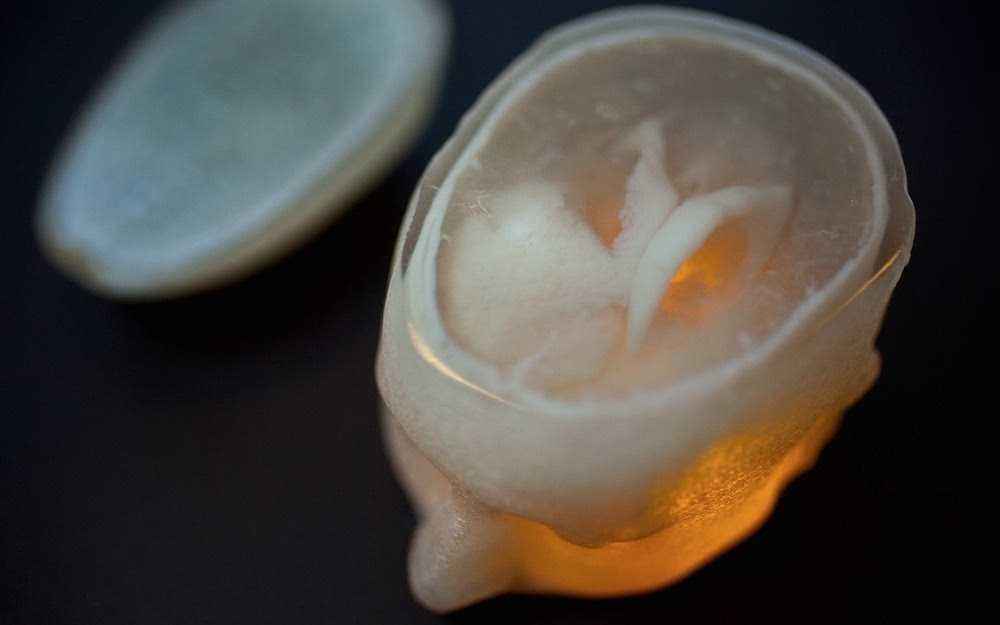 牟平区中医医院又一次成功应用3D打印技术完成脑出血手术