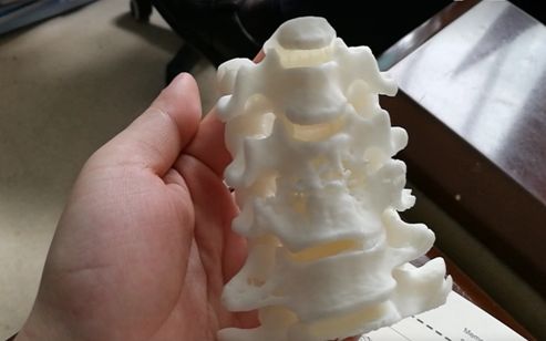 铜川市成功完成首例“3D打印导板技术”应用到骨科中的手术