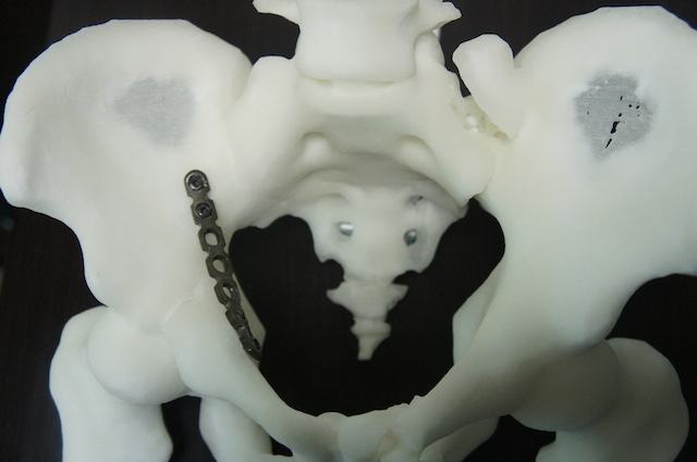 石排医院借助3D打印技术，实现骨科手术“私人订制”