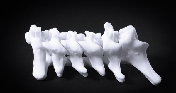 克拉古耶瓦茨大学科学家提出使用3D技术来诊断脊柱侧凸