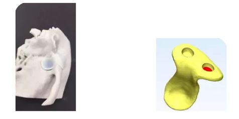 广州市妇女儿童医疗中心医生借3D打印为下巴致颅底穿洞的男孩补洞