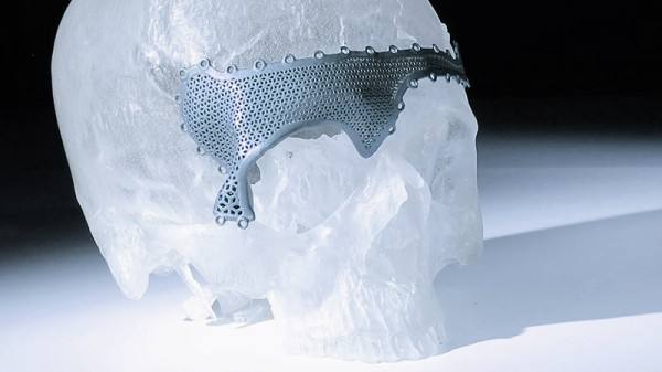 哈市第五医院成功应用3D打印完成一例复杂的颅骨成型术