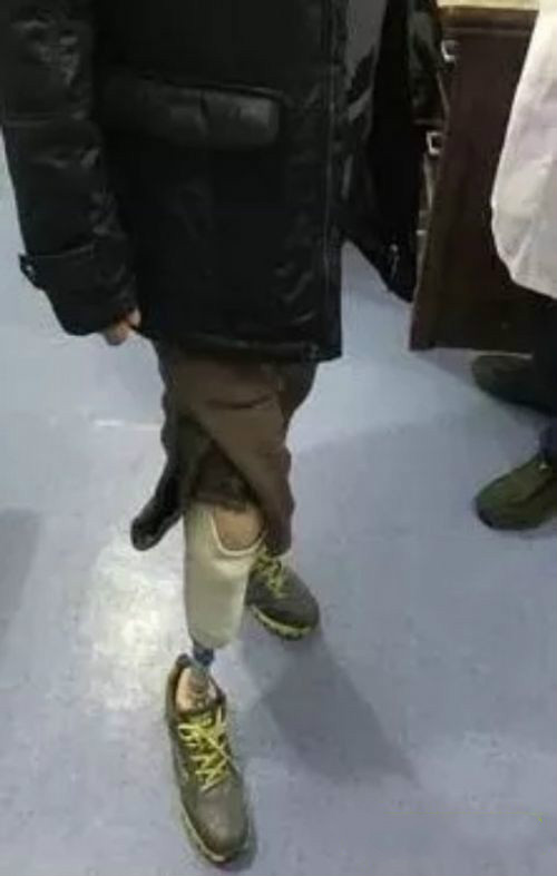 鞍钢小腿截肢退休工人戴上辽宁首个3D打印义肢，两个字：舒适