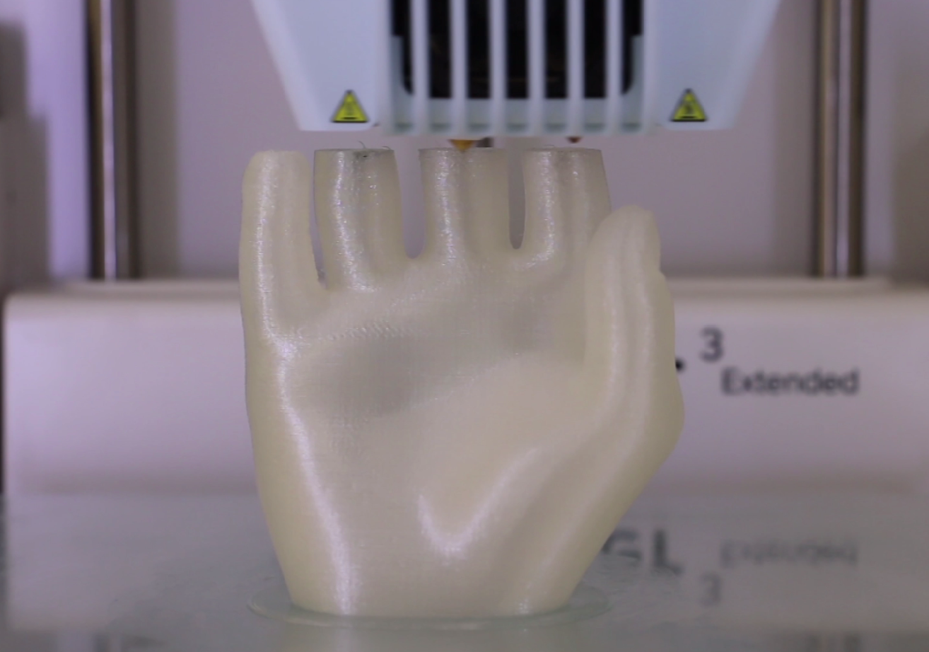 爱心无价！无国界医生运用3D打印技术帮助残肢病人打印缺失的假肢