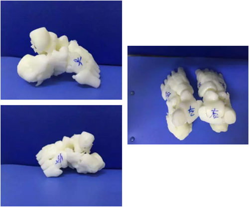 郴州市第四人民医院应用3D打印技术为侧跟骨粉碎性骨折患者实施手术
