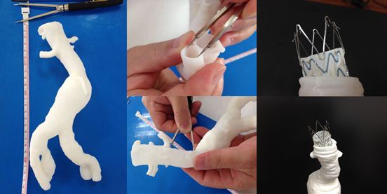 兰大二院3D打印辅助“体外开窗”技术成功治愈罕见胸主动脉夹层患者