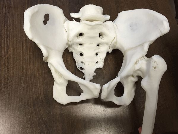 闽东医院骨科医生借助3D打印技术成功完成复杂骨盆骨折手术