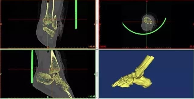 西安高新医院成功实施3D打印人工距骨假体植入手术
