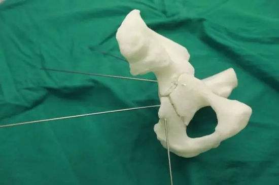 3D打印助力番禺区石碁人民医院骨科个性化治疗