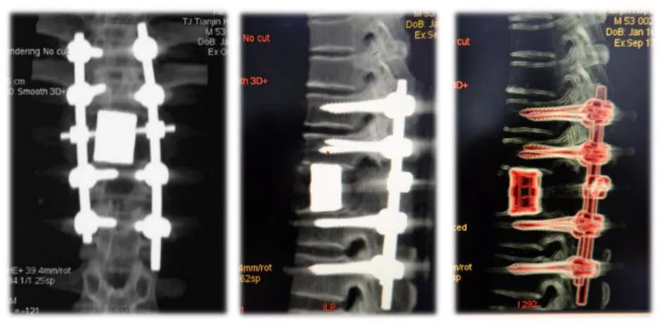 天津医院成功完成首例植入3D打印人工椎体手术