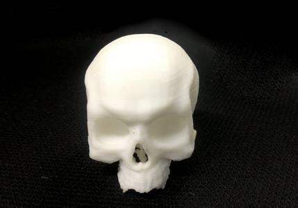 男婴患上万分之六的怪病 3D打印技术帮他重拼颅骨