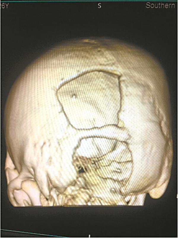 惊险万分！小伙子被钢筋穿头，幸得3D打印补全颅骨