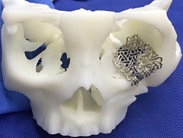 湖南省郴州市第一人民医院首例“3D打印眼科手术”成功完成