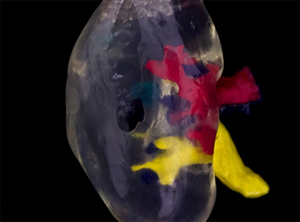 贝尔法斯特外科医生在3D打印模型的帮助下完成复杂的肾移植手术