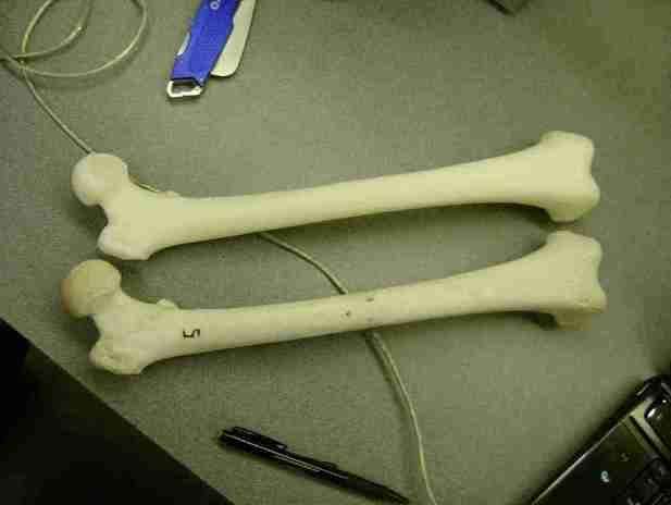 衡阳市中心医院应用3D打印技术助力粉碎性骨折患者康复