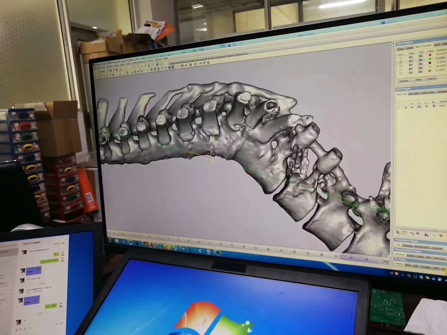 哈医大一院数字骨科成功完成又一例3D打印技术的脊柱高难度手术