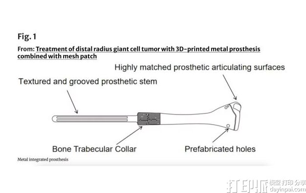 研究人员成功应用3D打印钛合金假体治疗腕部肿瘤